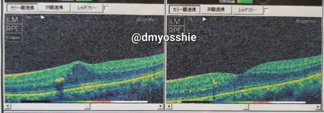 糖尿病黄斑浮腫のビフォーアフター画像