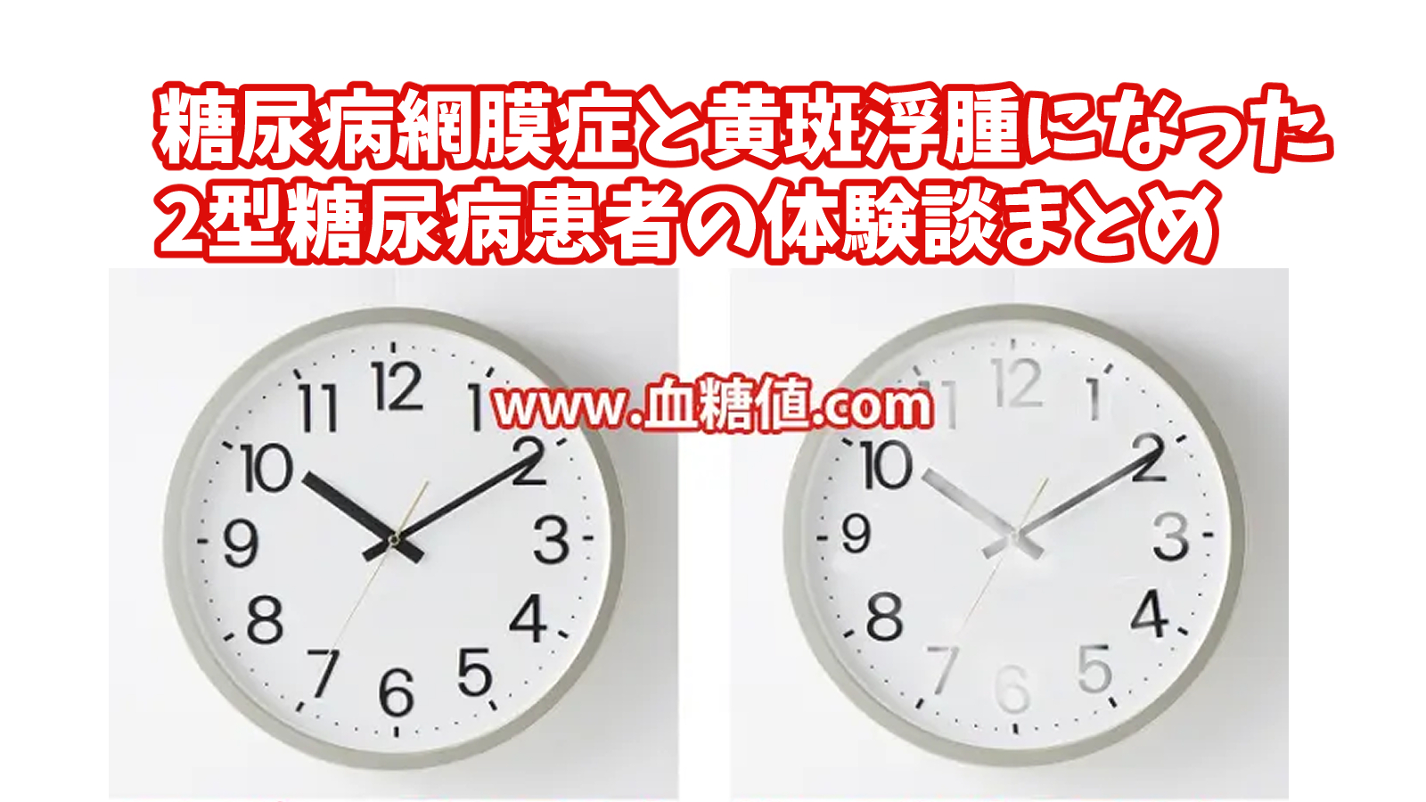 糖尿病網膜症と黄斑浮腫が治った体験談まとめ